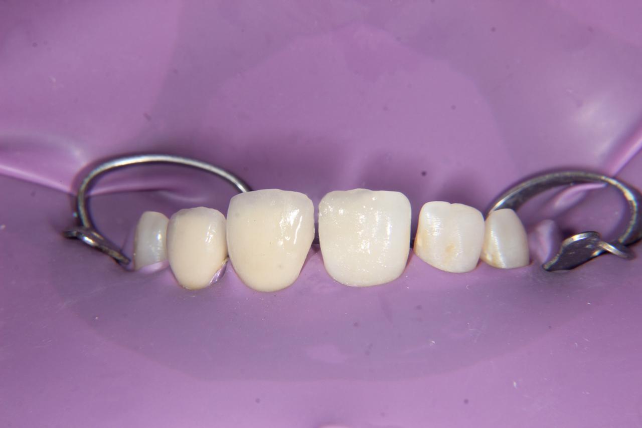 Rubber Dam Isolation